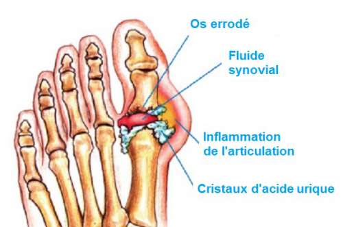 schéma montrant une arthrose du doigt de pied
