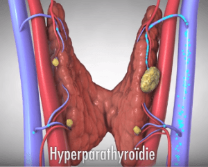 les risques liés à l'hyperparathyroïdie