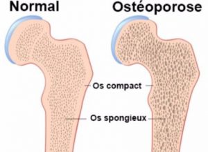 comparatif entre un os normal et un os atteint d'ostéoporose