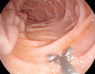 intestin grele biopsie duodenale